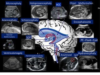 Schizencephaly
Encephalocele
Microcephaly
Anencephaly
Chiari Malforma3on
Head normal or small
Dia
Ventriculomegaly Hydranecphaly
s
:
Holoprosencephaly
Hemimegalencephaly Arachnoid cyst
ACC
SOP
PF-‐Fluid-‐Cyst
Yong seok et a
Vascular
Malforma3ons
 