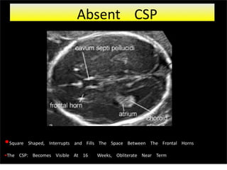 •Square Shaped, Interrupts and Fills The Space Between The Frontal Horns
•The CSP: Becomes Visible At 16 Weeks, Obliterate Near Term
Absent CSP
 