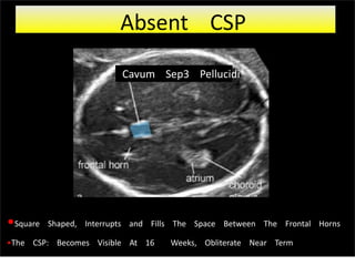 •Square Shaped, Interrupts and Fills The Space Between The Frontal Horns
•The CSP: Becomes Visible At 16 Weeks, Obliterate Near Term
Cavum Sep3 Pellucidi
Absent CSP
 