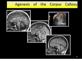 38
Agenesis of the Corpus Callosum
 