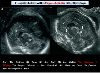 Only The Rostrum (1), Genu (2) And Body (3) Are Visible; The Splenium Is
Missing. The Corpus Callosum Is Short Posteriorly And Does Not Seem To Overlay
The Quadrigeminal Plate
21-‐week Fetus With Par=al Agenesis Of The Corpus Callosum
 