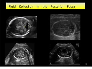 41
Fluid Collec3on in the Posterior Fossa
 