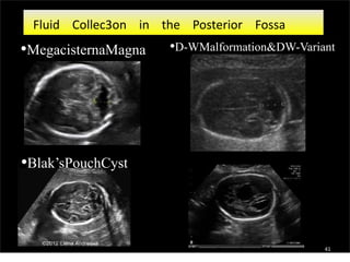 Fluid Collec3on in the Posterior Fossa
•MegacisternaMagna •D-WMalformation&DW-Variant
•Blak’sPouchCyst
41
 