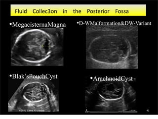 Fluid Collec3on in the Posterior Fossa
•MegacisternaMagna
•Blak’sPouchCyst
•D-WMalformation&DW-Variant
•ArachnoidCyst
41
 