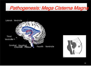 Choriod Plexus
Pathogenesis: Mega Cisterna Magna
Lateral Ventricle
Third
Ventricle
Cerebral Aqueduct
Fourth Ventricle
44
 