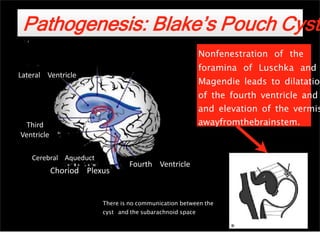 Lateral Ventricle
Third
Ventricle
Cerebral Aqueduct
Choriod Plexus
foramina of Luschka and
Magendie leads to dilatation
of the fourth ventricle and
and elevation of the vermis
awayfromthebrainstem.
Fourth Ventricle
Pathogenesis: Blake’s Pouch Cyst
Nonfenestration of the
There is no communication between the
cyst and the subarachnoid space
47
 
