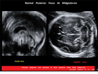 Normal Posterior Fossa At Midgesta=on
SagiGal viewAxial view
Prenatal diagnosis and outcome of fetal posterior fossa ﬂuid Collec=ons
Gandolﬁ Colleoni et al., UOG 20
 
