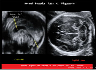SagiGal viewAxial view
Normal Posterior Fossa At Midgesta=on
Cavum Sep3
Pellucidi
Prenatal diagnosis and outcome of fetal posterior fossa ﬂuid Collec=ons
Gandolﬁ Colleoni et al., UOG 20
 