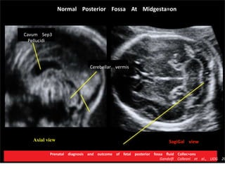 SagiGal viewAxial view
Normal Posterior Fossa At Midgesta=on
Cavum Sep3
Pellucidi
Cerebellar vermis
Prenatal diagnosis and outcome of fetal posterior fossa ﬂuid Collec=ons
Gandolﬁ Colleoni et al., UOG 20
 
