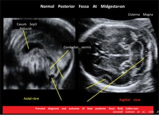 SagiGal viewAxial view
Normal Posterior Fossa At Midgesta=on
Cisterna Magna
Cavum Sep3
Pellucidi
Cerebellar vermis
Prenatal diagnosis and outcome of fetal posterior fossa ﬂuid Collec=ons
Gandolﬁ Colleoni et al., UOG 20
 
