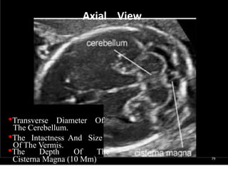 79
Axial View
•Transverse Diameter Of
The Cerebellum.
•The Intactness And Size
Of The Vermis.
•The Depth Of The
Cisterna Magna (10 Mm)
 