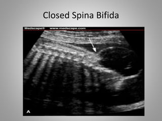 Closed Spina Bifida
 