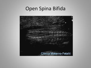 Open Spina Bifida
 