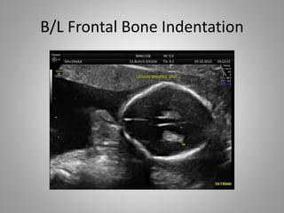 B/L Frontal Bone Indentation
 