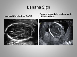 Banana Sign
Normal Cerebellum & CM
Banana shaped Cerebellum with
obliterated CM
 