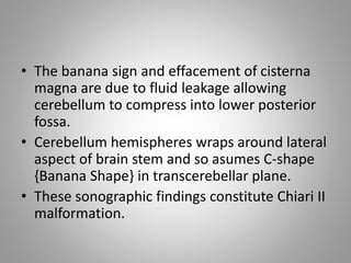 • The banana sign and effacement of cisterna
magna are due to fluid leakage allowing
cerebellum to compress into lower posterior
fossa.
• Cerebellum hemispheres wraps around lateral
aspect of brain stem and so asumes C-shape
{Banana Shape} in transcerebellar plane.
• These sonographic findings constitute Chiari II
malformation.
 