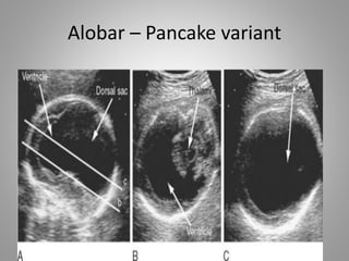 Alobar – Pancake variant
 