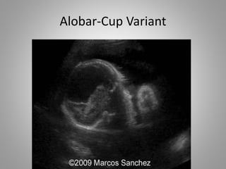 Alobar-Cup Variant
 