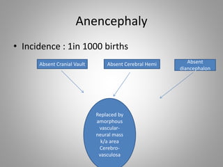 Anencephaly
• Incidence : 1in 1000 births
Absent Cranial Vault Absent Cerebral Hemi Absent
diancephalon
Replaced by
amorphous
vascular-
neural mass
k/a area
Cerebro-
vasculosa
 