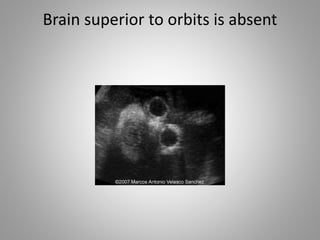 Brain superior to orbits is absent
 