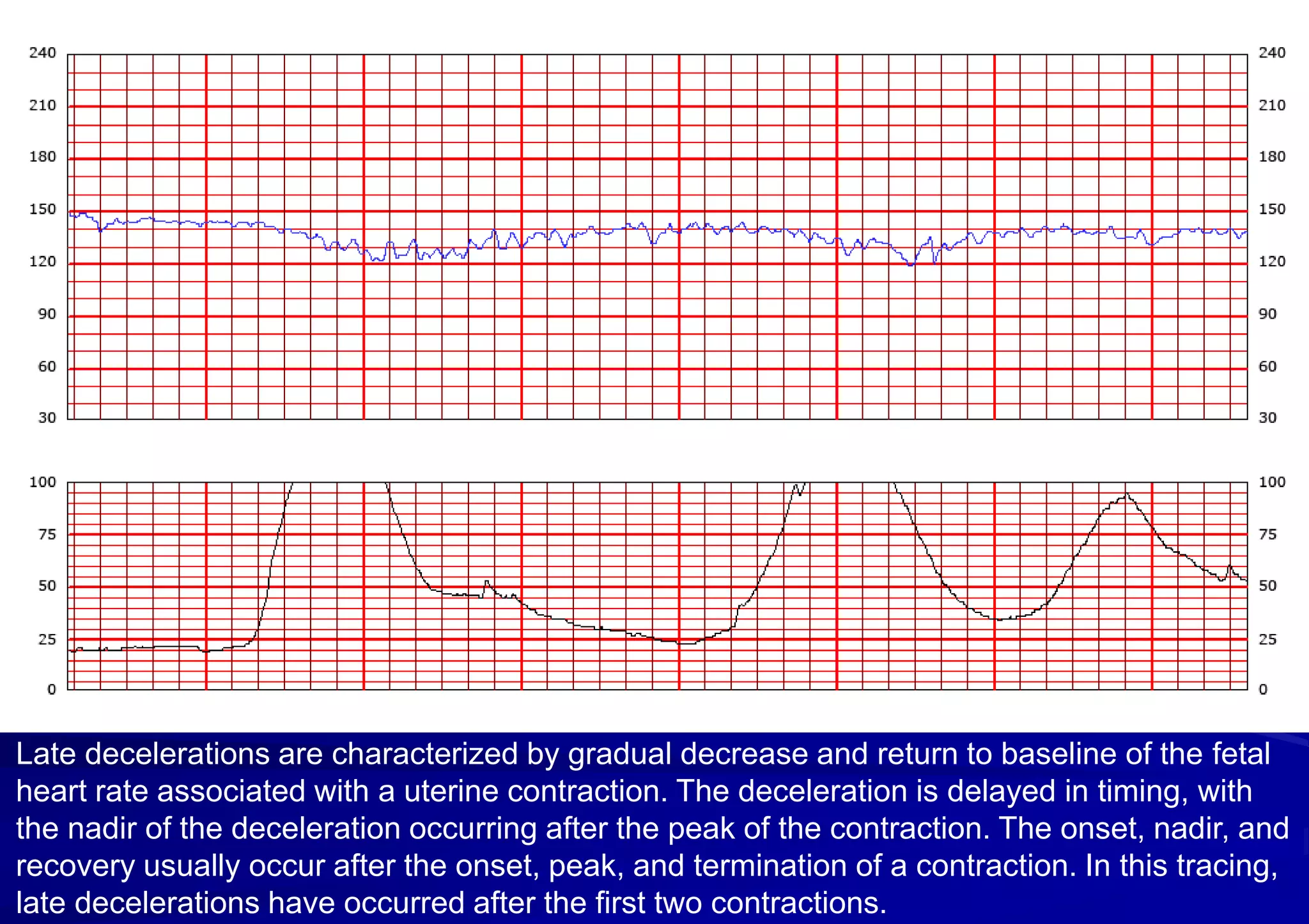 Late decelerations are characterized by gradual decrease and return to baseline of the fetal
heart rate associated with a uterine contraction. The deceleration is delayed in timing, with
the nadir of the deceleration occurring after the peak of the contraction. The onset, nadir, and
recovery usually occur after the onset, peak, and termination of a contraction. In this tracing,
late decelerations have occurred after the first two contractions.
 