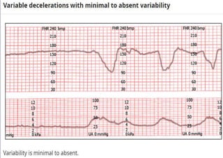 Fetal Cardiotocograph (CTG).pptx