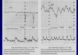 Fetal Cardiotocograph (CTG).pptx