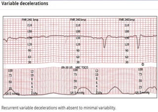 Fetal Cardiotocograph (CTG).pptx