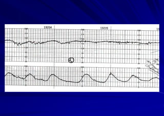 Fetal Cardiotocograph (CTG).pptx