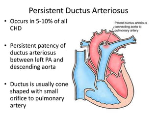 Persistent Ductus Arteriosus
• Occurs in 5-10% of all
CHD
• Persistent patency of
ductus arteriosus
between left PA and
descending aorta
• Ductus is usually cone
shaped with small
orifice to pulmonary
artery
 