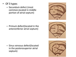 • Of 3 types
– Secundum defect (most
common,located in middle
portion of atrial septum)
– Primum defect(located in the
anteroinferior atrial septum)
– Sinus venosus defect(located
in the posterosuperior atrial
septum)
 