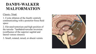 Torcular Inversion FETAL CENTRAL NERVOUS SYSTEM ANAOMALIES PRESENTATION | PPTX