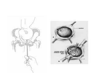 fetal craniotomy. by midwifery students. | PPTX