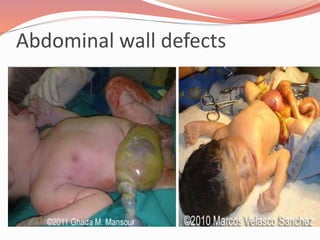 Abdominal wall defects
 
