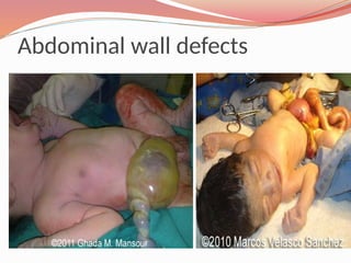 Abdominal wall defects
 