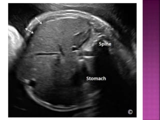Fetal doppler & fetal growth