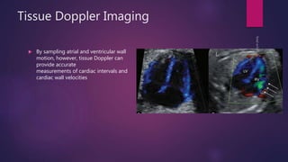 Tissue Doppler Imaging
 By sampling atrial and ventricular wall
motion, however, tissue Doppler can
provide accurate
measurements of cardiac intervals and
cardiac wall velocities
 