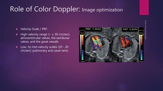 Role of Color Doppler: Image optimization
 Velocity Scale / PRF:
 High-velocity range (> ± 30 cm/sec):
atrioventricular valves, the semilunar
valves, and the great vessels
 Low- to mid-velocity scales (10 - 20
cm/sec): pulmonary and caval veins
 