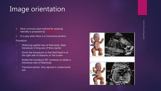Image orientation
 Most common used method for assesing
laterality is proposed by Cordes et al.
 It is easy when fetus is in transverse position
Procedure:
1. Obtaining sagittal view of fetal body. Align
transducer in long axis of fetus (spine)
1. Orient the transducer so that fetal head is on
the right side of observer on the screen
2. Rotate the transducer 90* clockwise to obtain a
transverse view of fetal body
3. Tranverse section thus aquired is caudocranial
axis
 