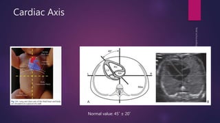 Cardiac Axis
Normal value: 45˚ ± 20˚
 
