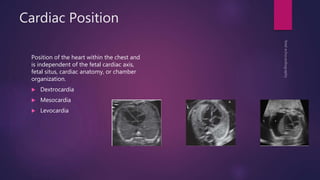 Cardiac Position
Position of the heart within the chest and
is independent of the fetal cardiac axis,
fetal situs, cardiac anatomy, or chamber
organization.
 Dextrocardia
 Mesocardia
 Levocardia
 