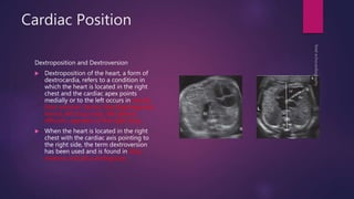 Cardiac Position
Dextroposition and Dextroversion
 Dextroposition of the heart, a form of
dextrocardia, refers to a condition in
which the heart is located in the right
chest and the cardiac apex points
medially or to the left occurs in results
from extrinsic factors like diaphragmatic
hernia, left lung mass, left pleural
effusion, agenesis of the right lung
 When the heart is located in the right
chest with the cardiac axis pointing to
the right side, the term dextroversion
has been used and is found in situs
inversus and situs ambiguous
 
