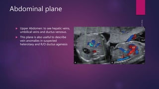 Abdominal plane
 Upper Abdomen: to see hepatic veins,
umbilical veins and ductus venosus.
 This plane is also useful to describe
vein anomalies in suspected
heterotaxy and R/O ductus agenesis
 