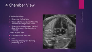 4 Chamber View
Scanning Technique
1. Determine the fetal situs
2. Obtain a transverse plane of the fetal
abdomen: full length rib is visible
3. slide the transducer toward the fetal
chest till proper 4 chamber view is
obtained
Criteria of good view:
 Complete rib on both side
 Apex
 Inferior pulmonary vein draining
posteriorly in LA
 