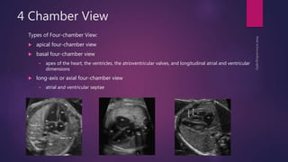 4 Chamber View
Types of Four-chamber View:
 apical four-chamber view
 basal four-chamber view
 apex of the heart, the ventricles, the atrioventricular valves, and longitudinal atrial and ventricular
dimensions
 long-axis or axial four-chamber view
 atrial and ventricular septae
 