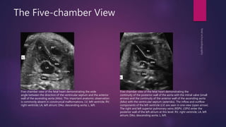 The Five-chamber View
Five-chamber view of the fetal heart demonstrating the
continuity of the posterior wall of the aorta with the mitral valve (small
arrows) and the continuity of the anterior wall of the ascending aorta
(AAo) with the ventricular septum (asterisks). The inflow and outflow
components of the left ventricle (LV) are seen in one view (open arrow).
The right and left superior pulmonary veins (RSPV, LSPV) enter the
posterior wall of the left atrium at this level. RV, right ventricle; LA, left
atrium; DAo, descending aorta; L, left.
Five-chamber view of the fetal heart demonstrating the wide
angle between the direction of the ventricular septum and the anterior
wall of the ascending aorta (AAo). This important anatomic observation
is commonly absent in conotruncal malformations. LV, left ventricle; RV,
right ventricle; LA, left atrium; DAo, descending aorta; L, left.
 
