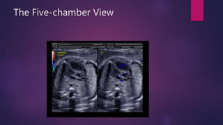 The Five-chamber View
 