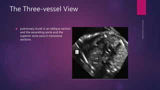 The Three-vessel View
 pulmonary trunk in an oblique section
and the ascending aorta and the
superior vena cava in transverse
sections
 