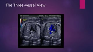 The Three-vessel View
 