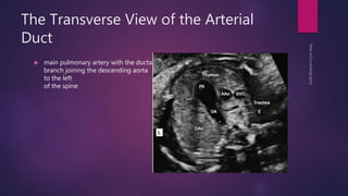 The Transverse View of the Arterial
Duct
 main pulmonary artery with the ductal
branch joining the descending aorta
to the left
of the spine
 